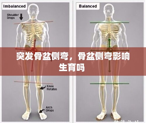 突发骨盆侧弯，骨盆侧弯影响生育吗 